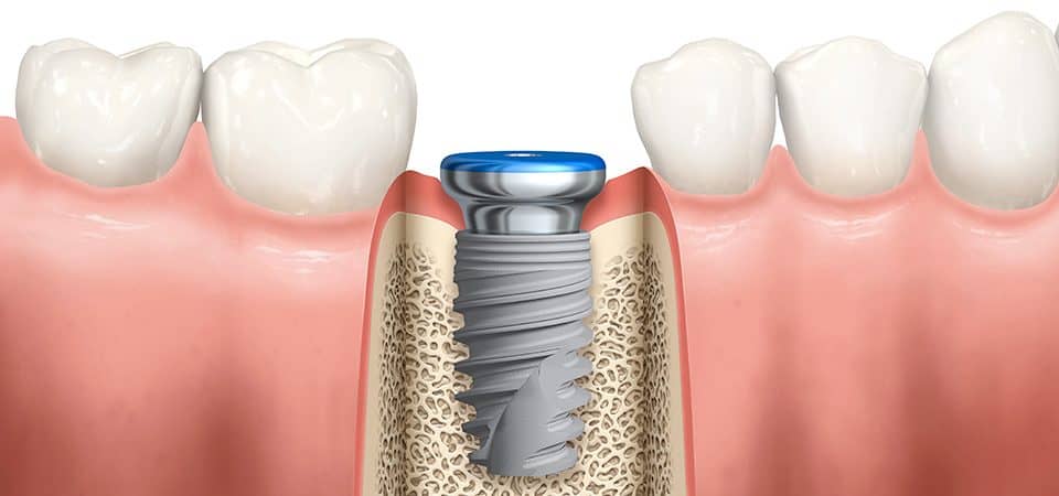 impianti dentali studio dentistico Spinetto Chiavari